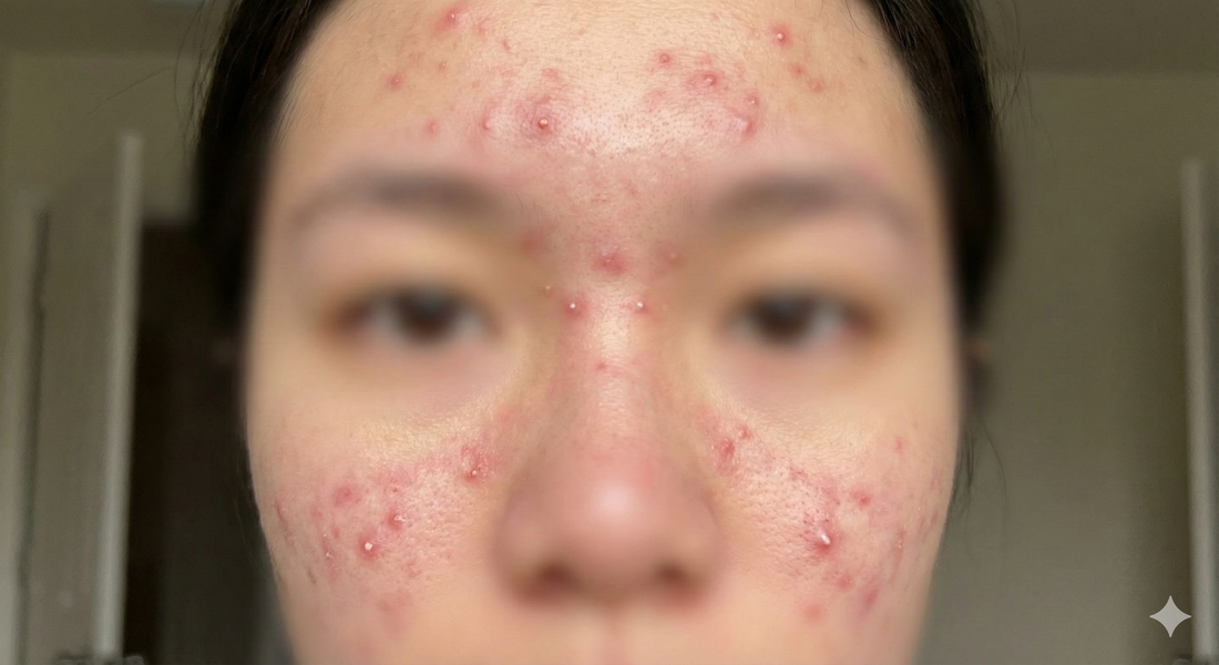 The Hidden Cost of VR Fitness: Why Your Headset is Causing Acne (And the Science-Backed Fix)